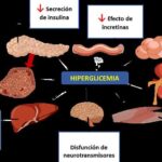Cetoacidosis diabética: Complicación grave de la diabetes tipo 1